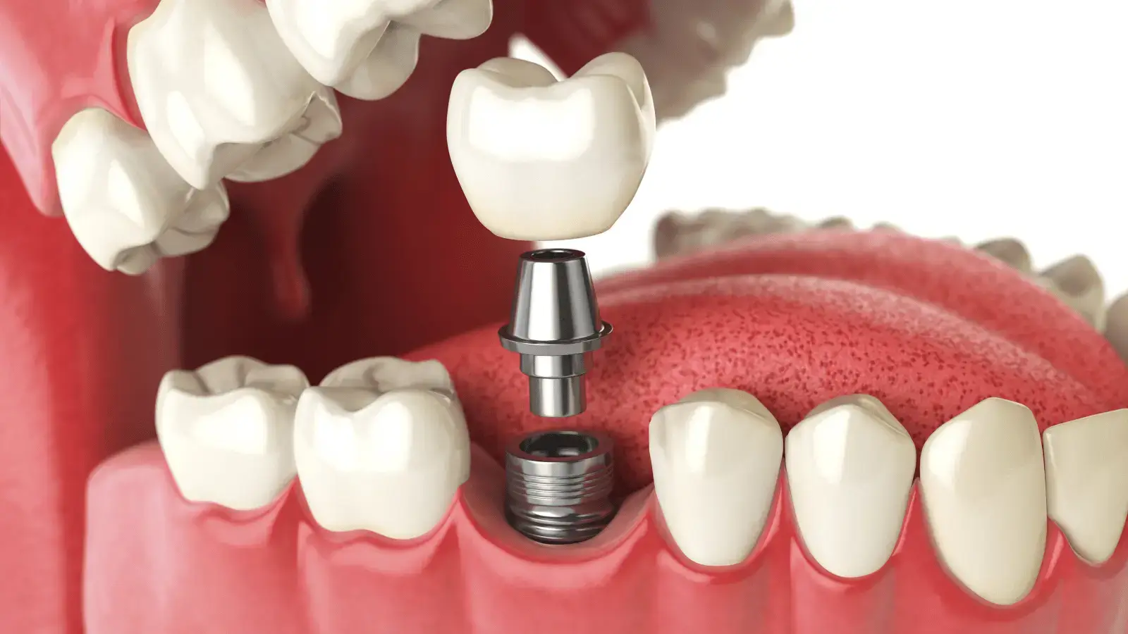 Decoding Dental Implant Pain What